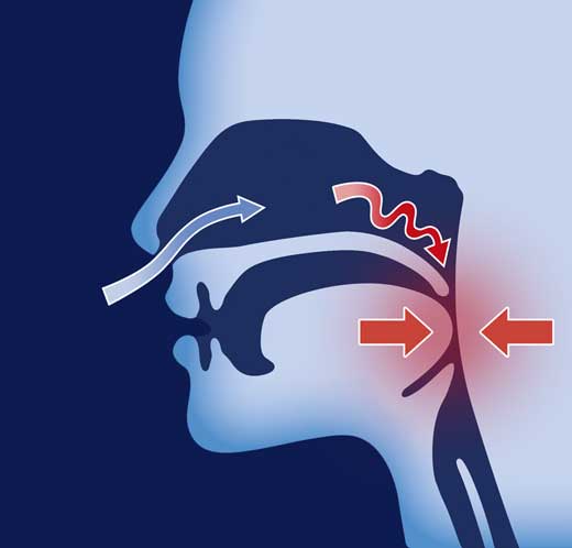 ONIRIS® : Arrêter de ronfler avec une solution anti-ronflement