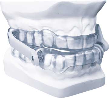 Anti-ronflement - orthèse mandibulaire
