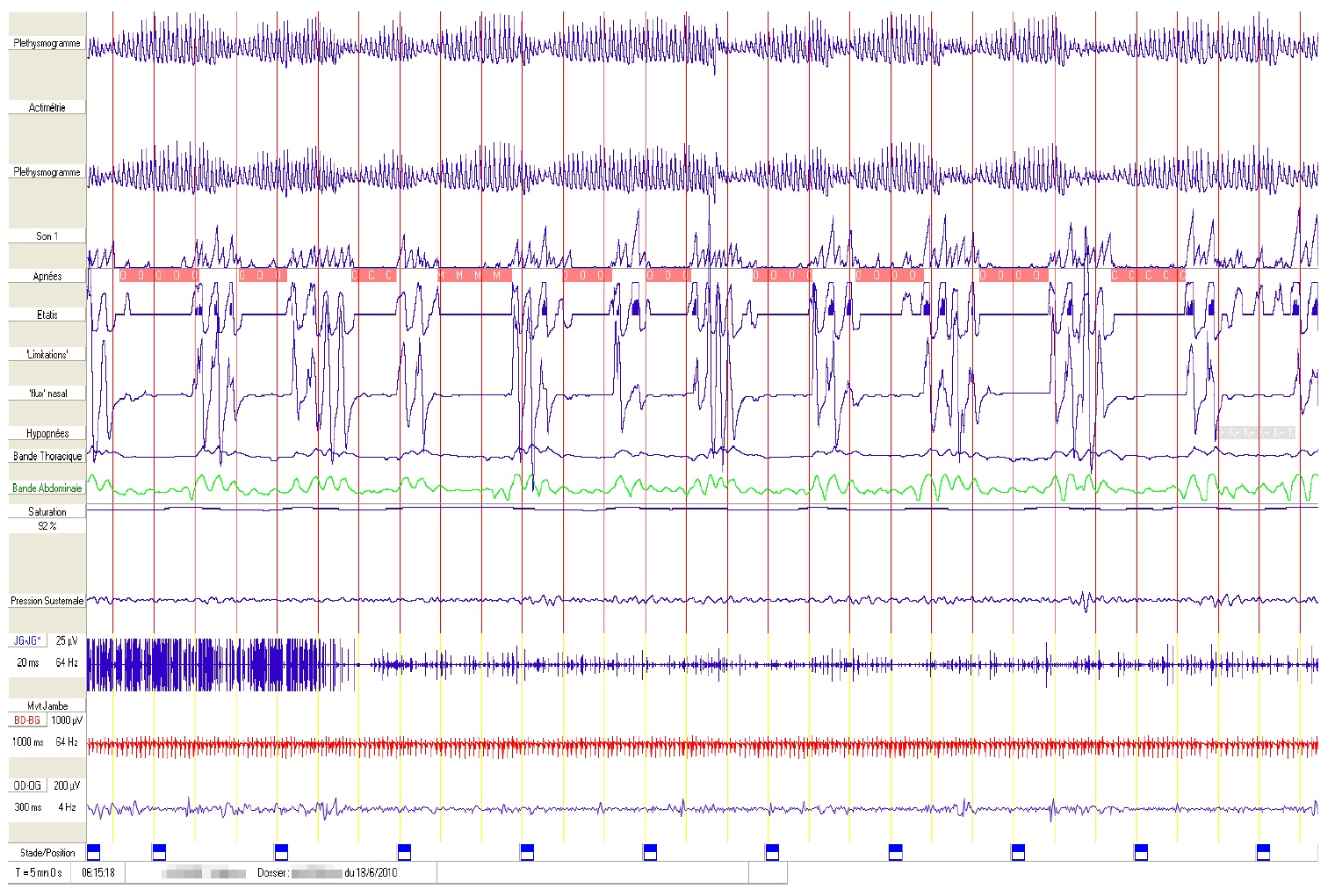 Tout savoir sur la polygraphie respiratoire du sommeil chez l